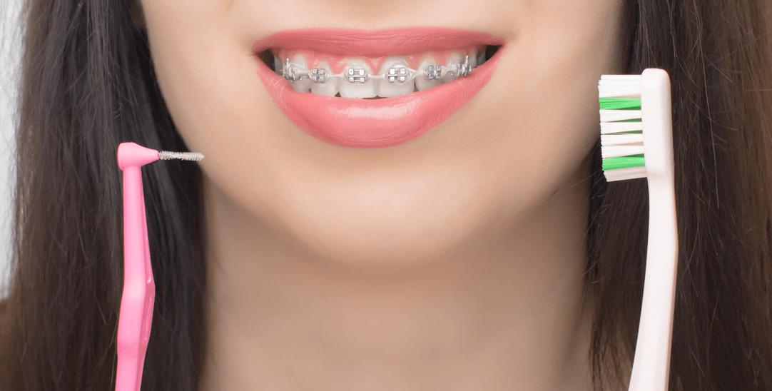 ¿Cómo cuidar tu higiene bucal si tienes brackets?